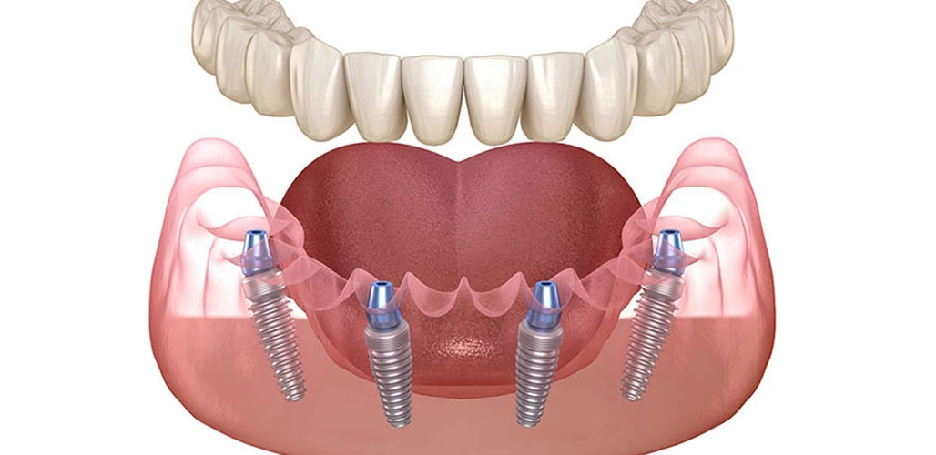 dental implant 