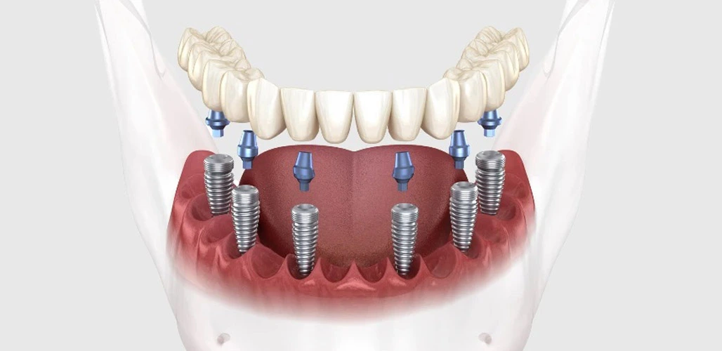 dental implant 