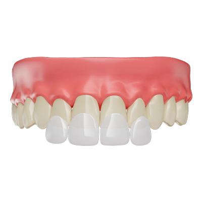 Hollywood Smile
