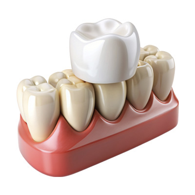 Hollywood Smile